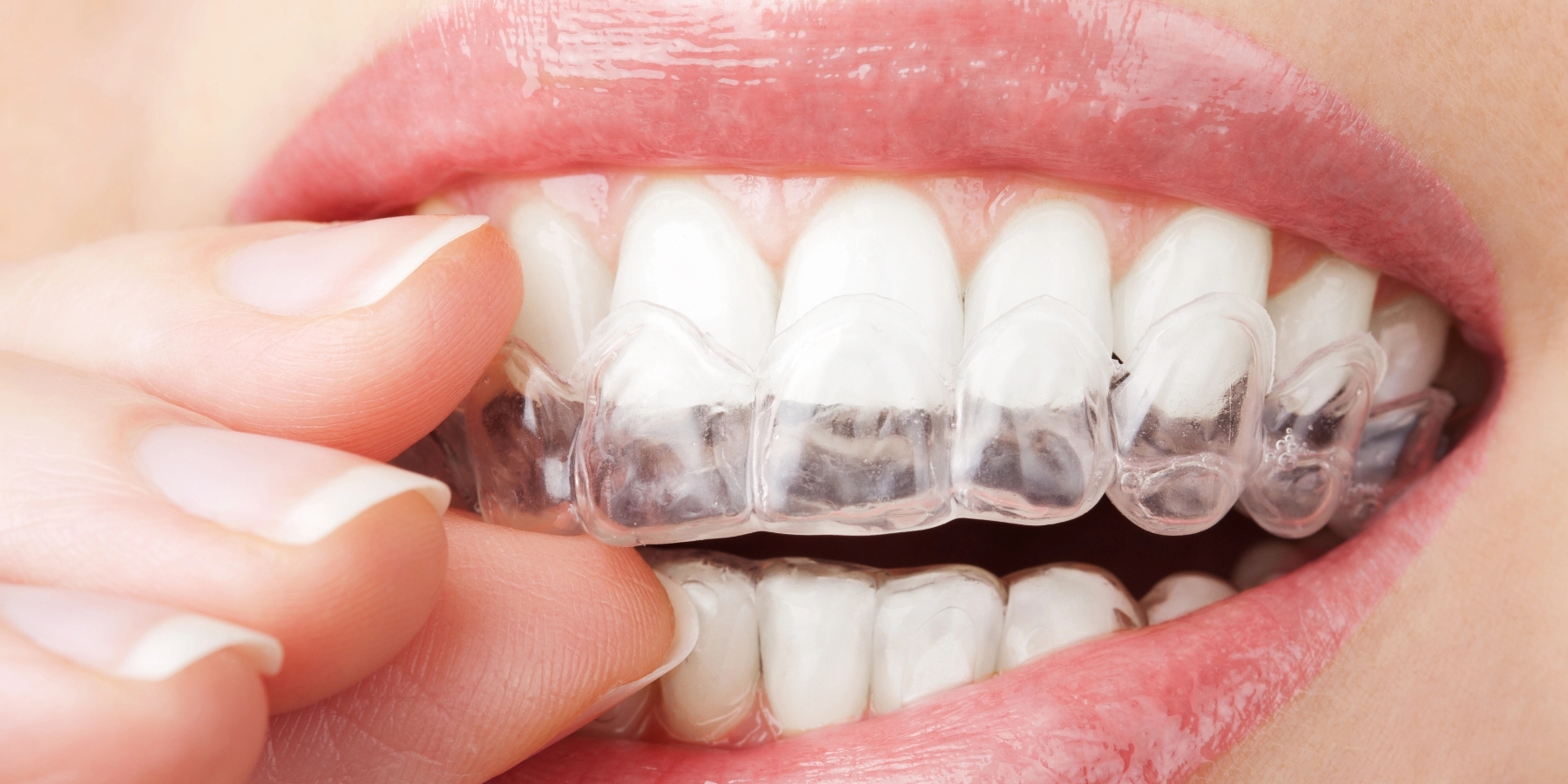 CDFZ Invisalign